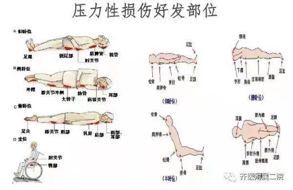 纵观压力性损伤