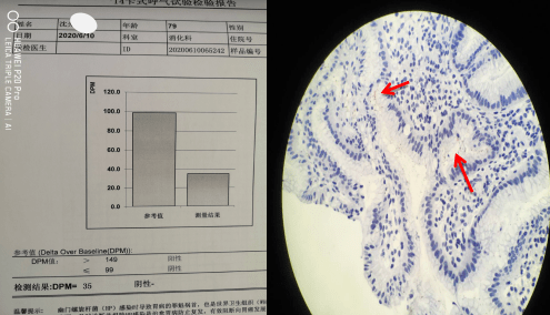 【医疗动态】幽门螺杆菌感染中的阳与阴—胃镜下诊断不可小觑!