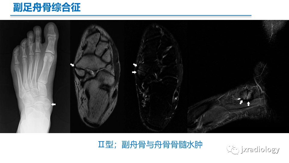 足副舟骨分型及相关病变