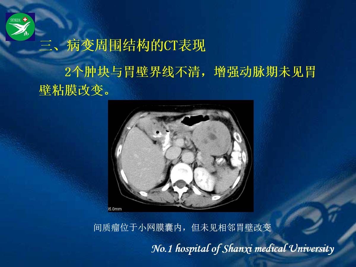 李健丁教授:胃肠道外间质瘤的ct表现和临床病理分析