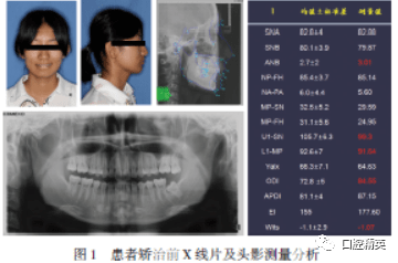 正畸-种植修复联合治疗下颌中切牙先天缺失1例