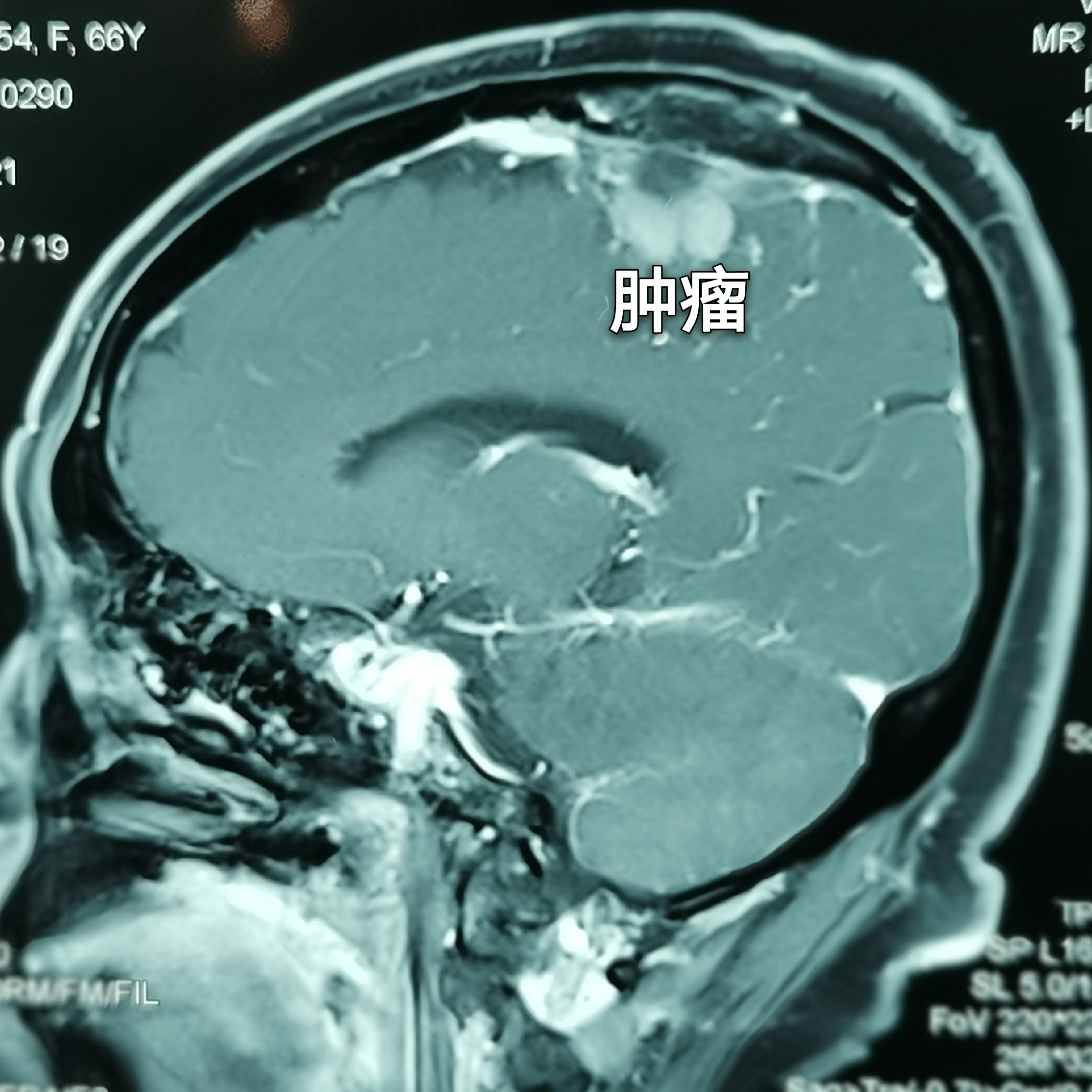 矢状窦旁脑膜瘤