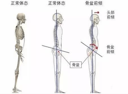 骨盆前倾的危害及简易鉴别