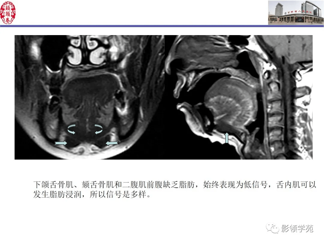 舌,口底影像解剖及常见疾病诊断