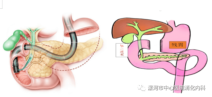 新技术市中心医院开展全市首例消化道改建术后毕ii式ercp取石术