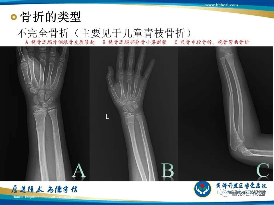 必须掌握!关于骨折的影像学评价