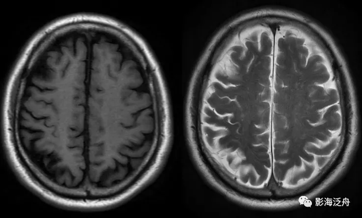 颅脑mr平扫中极易漏诊的点