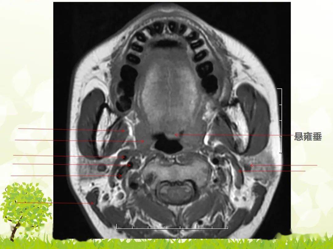 咽旁间隙解剖及常见病变影像表现