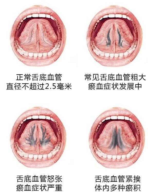 舌下"青筋"发出这3种"信号", 别大意了!_舌头