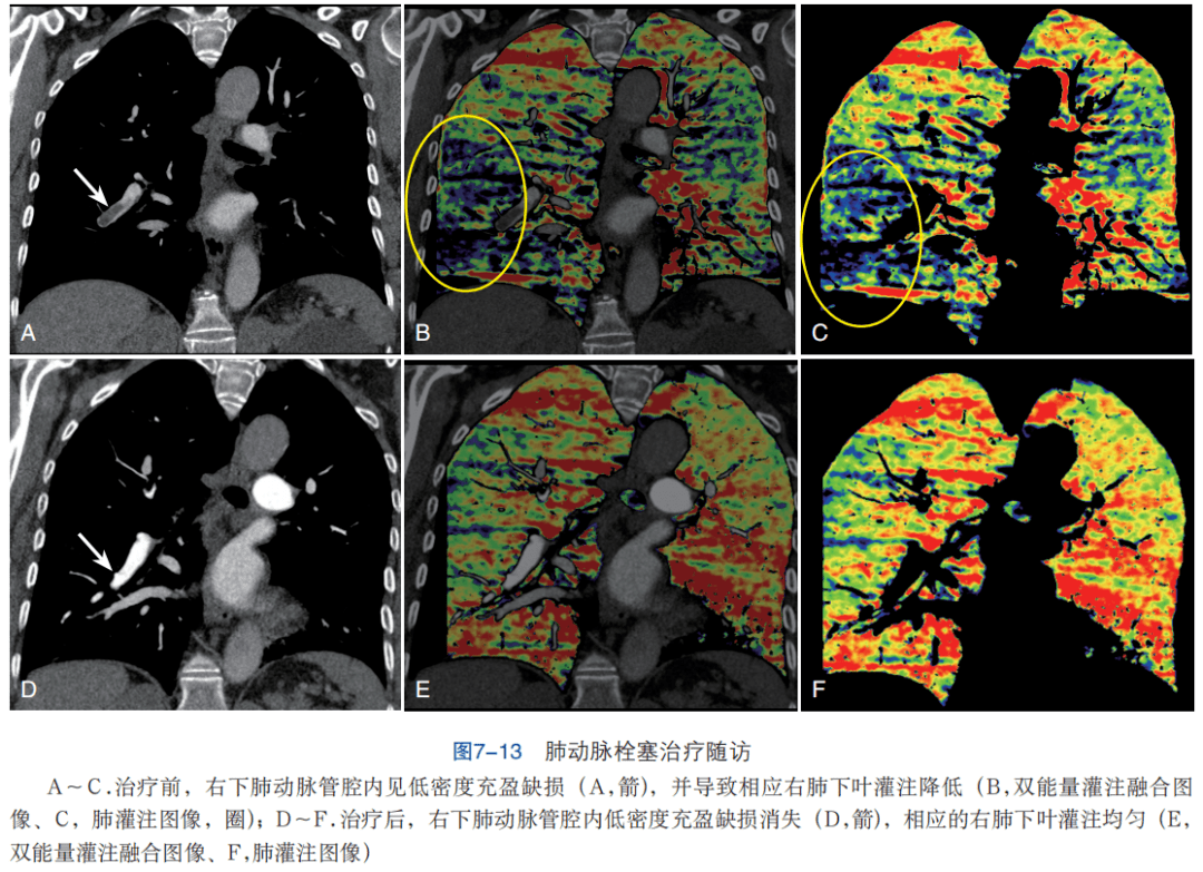 【干货】秒懂 ct血管成像检查和诊断要点:急性肺动脉栓塞