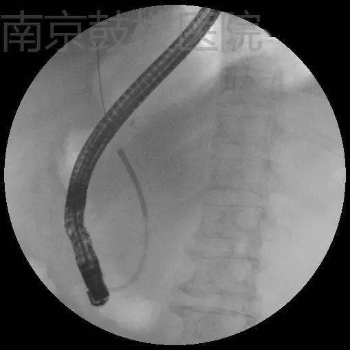 spyglass观察胆管:胆总管