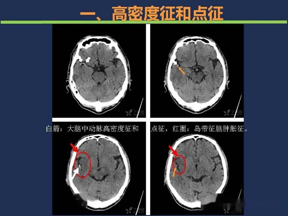 如何根据头颅ct预判超早期脑梗死?