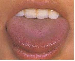 教你判断,一秒就会._舌苔