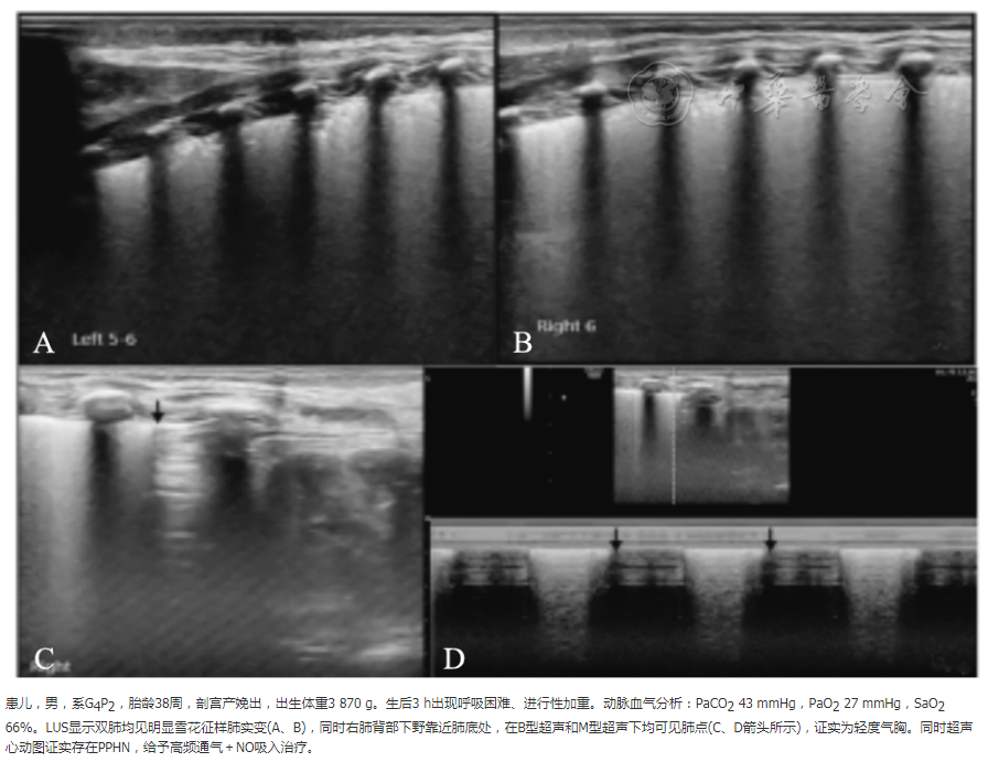呼吸窘迫综合征导致气胸和新生儿持续性肺动脉高压超声影像