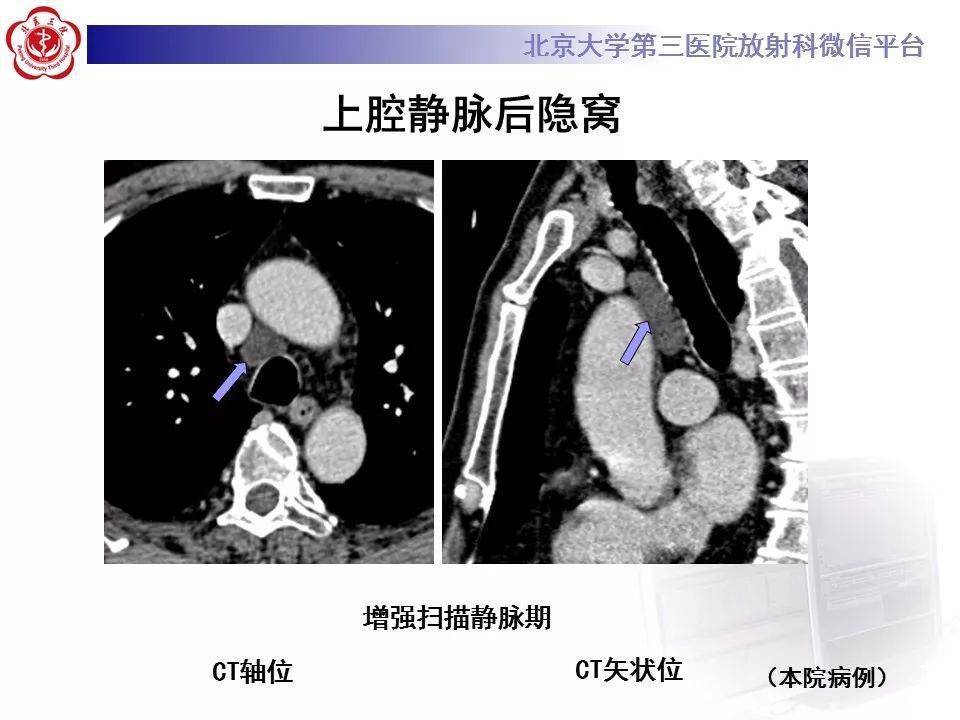 心包窦及心包隐窝解剖