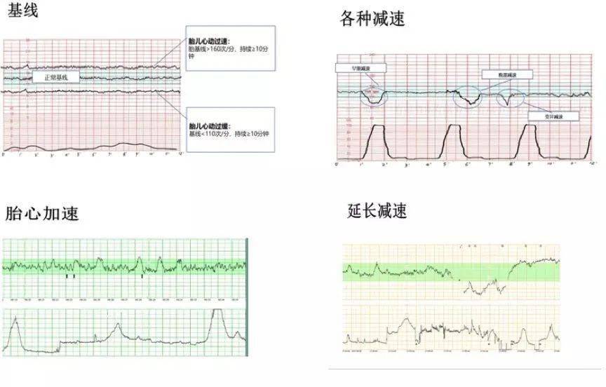 胎心监护判读评价指标图形分析检测时机全图文解读