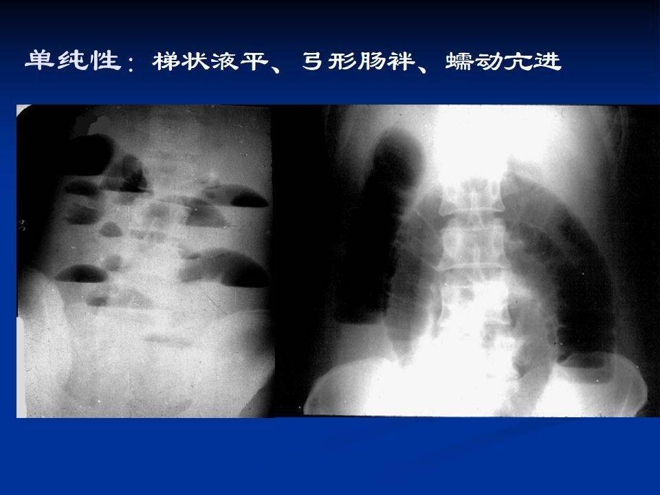 肠梗阻的分类及影像学表现(高清图片 文字讲解!_腹部