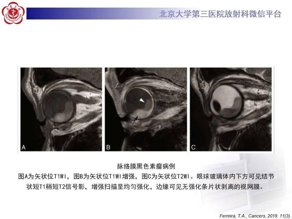 北医三院放射科病例723—神经五官