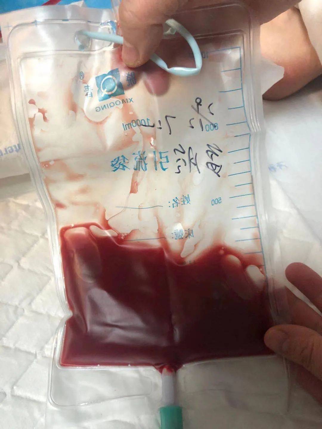 腹腔引流液