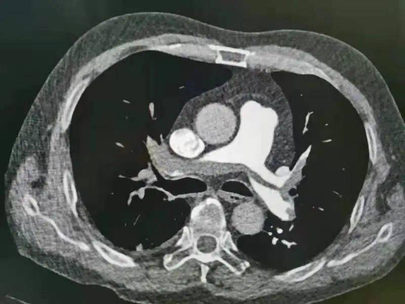 仁济健康丨警惕这个沉默的杀手肺栓塞