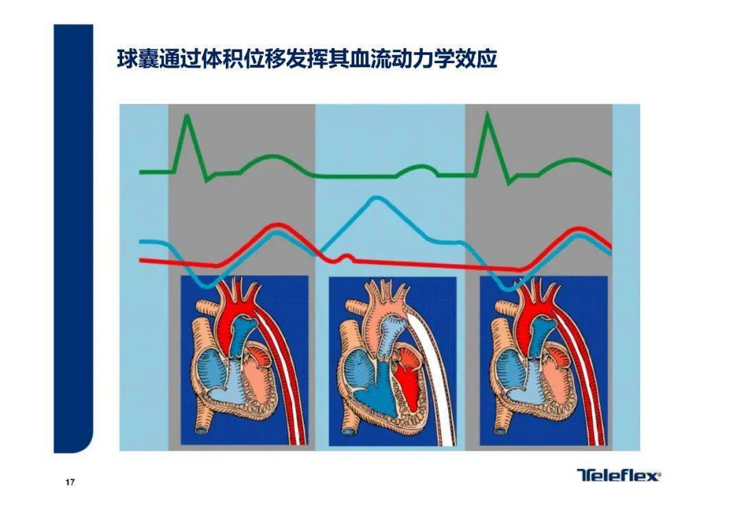 ppt主动脉内球囊反搏原理