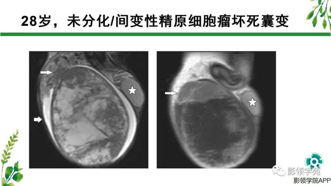 睾丸肿瘤mri诊断