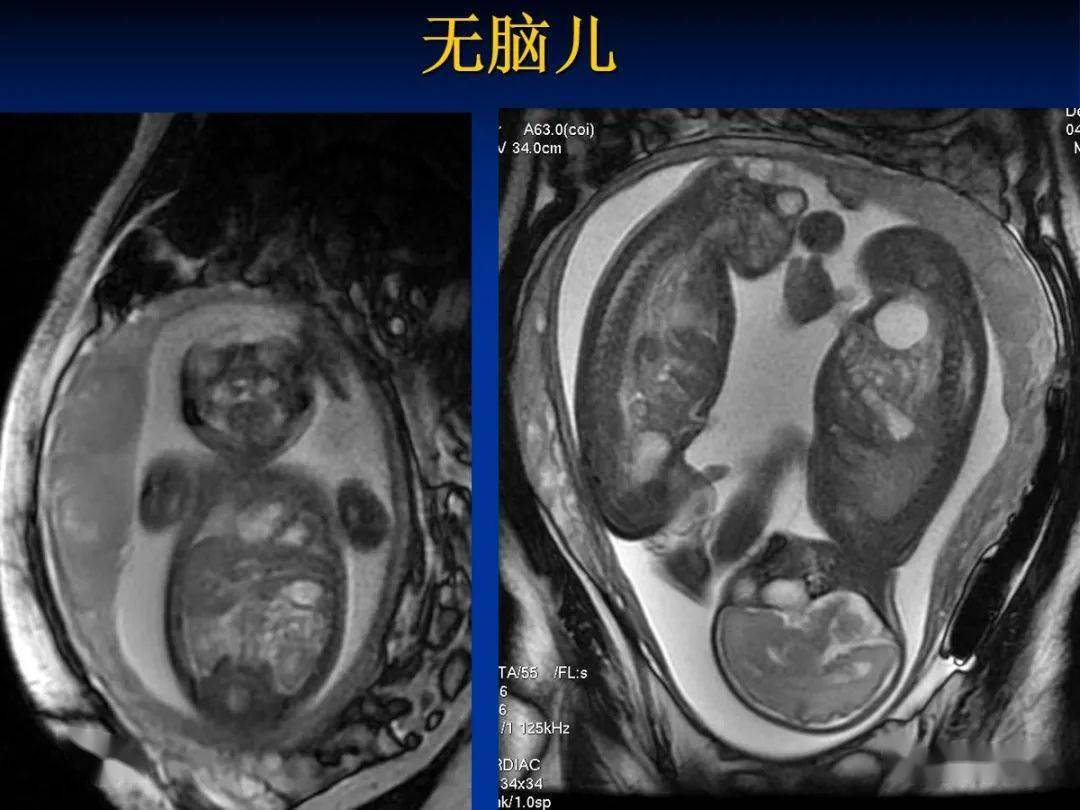 mri在胎儿神经系统畸形诊断中应用