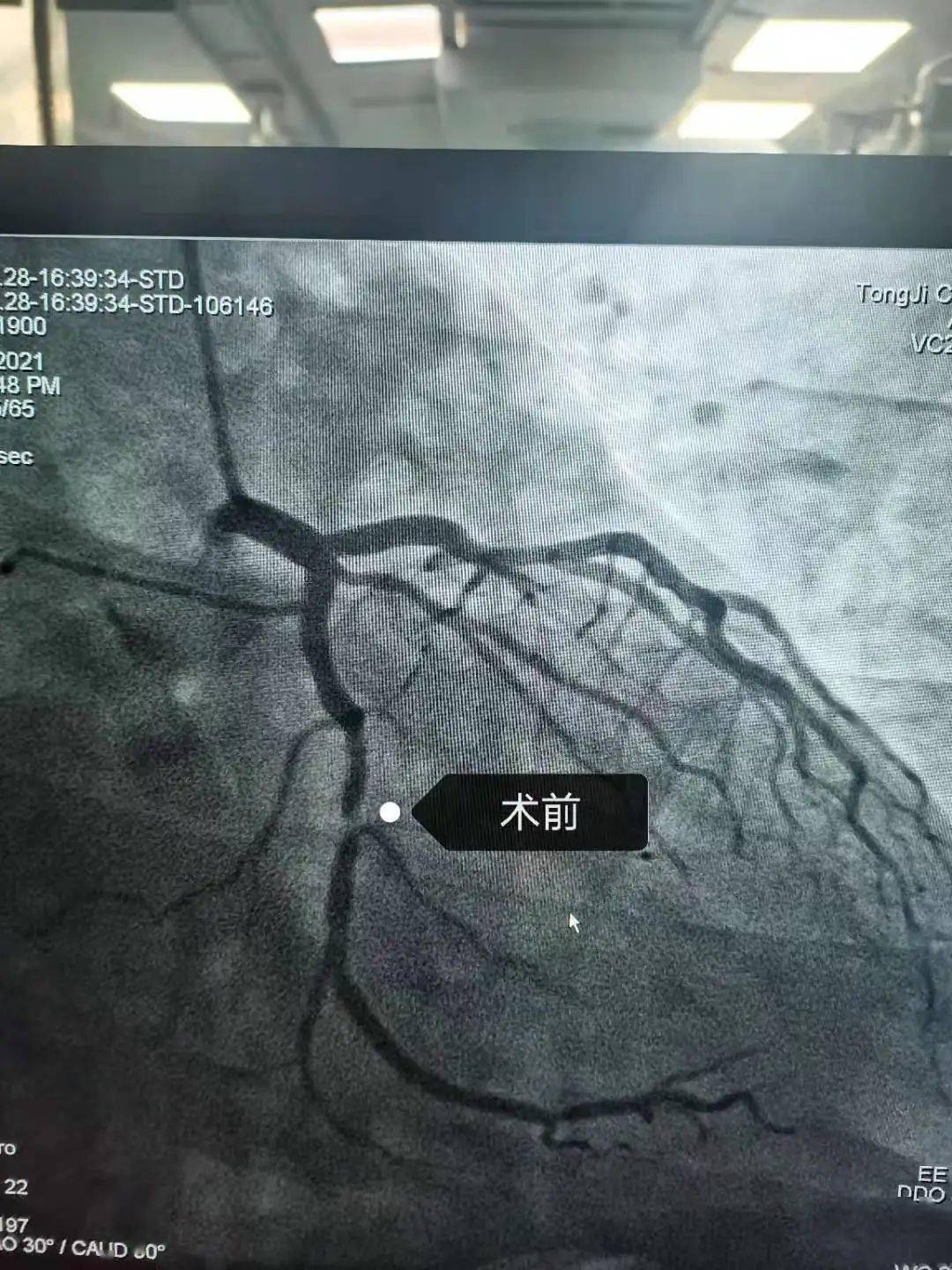 药物球囊——心脏支架以外的另一选择_心血管