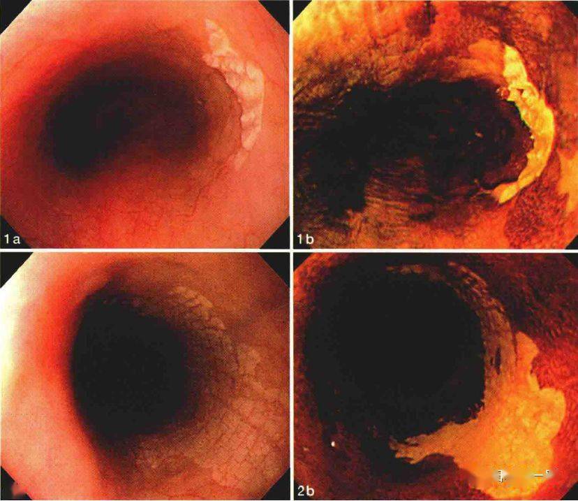 干货收藏 | 消化内镜40种常见病图谱_食管