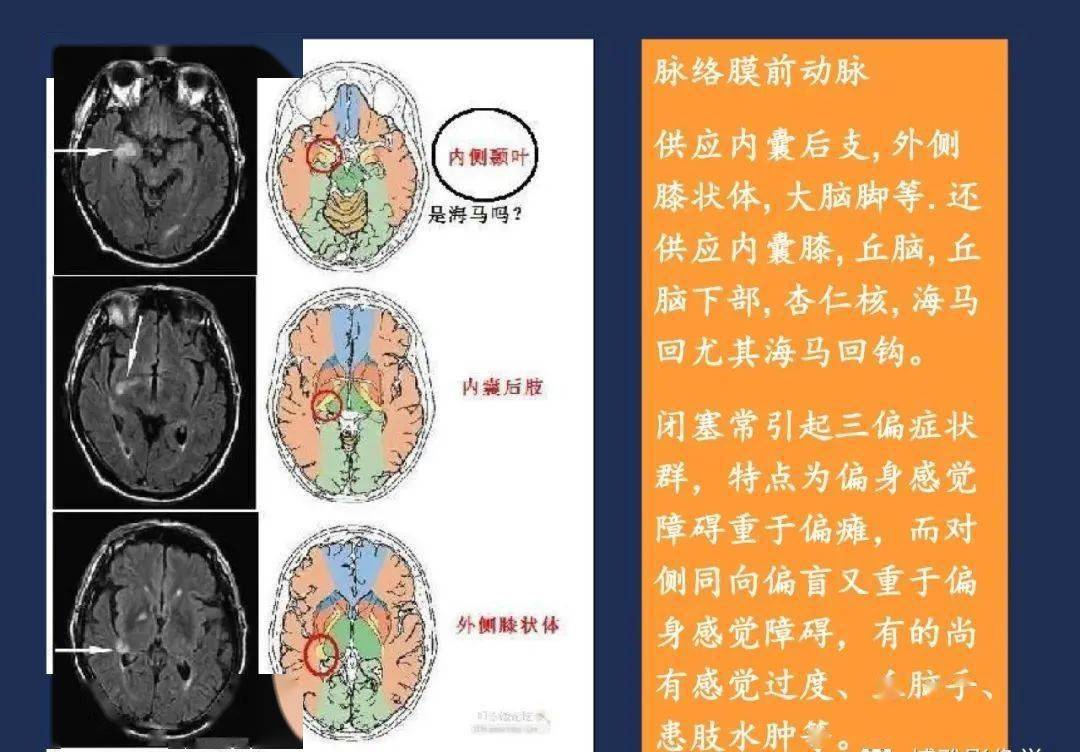 脉络膜前动脉纹状体动脉heubner返动脉大脑前动脉大脑中动脉颈内动脉