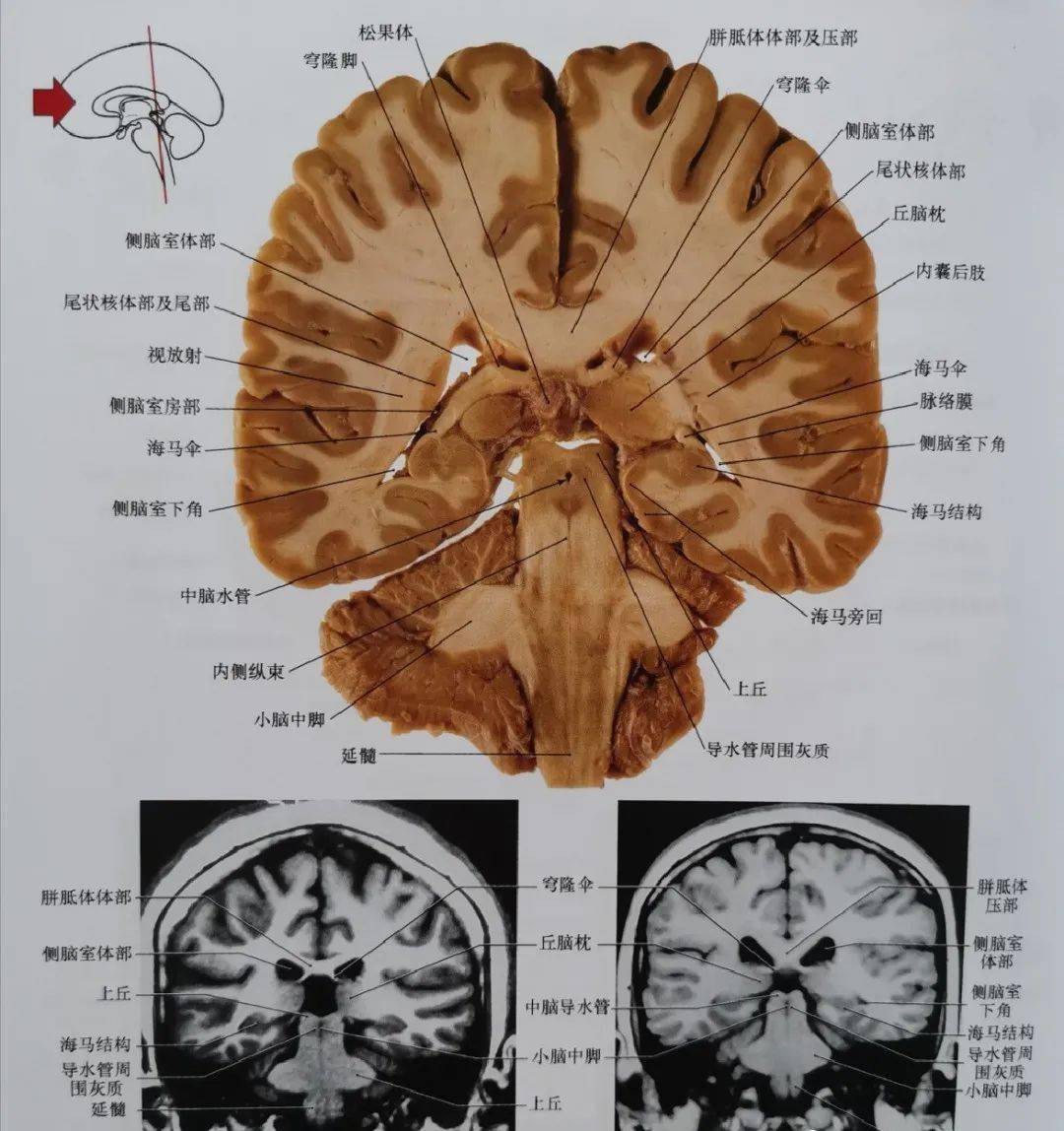 图6 通过丘脑枕核,内外侧膝状体核,中脑和脑桥被盖及延髓腹侧平面的