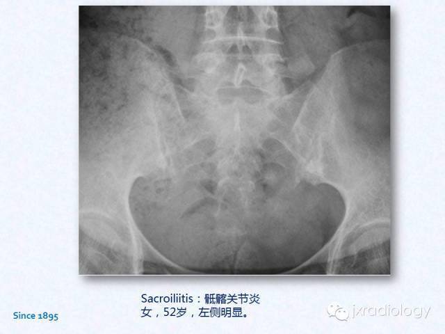 骶髂关节炎x线ct和mri表现