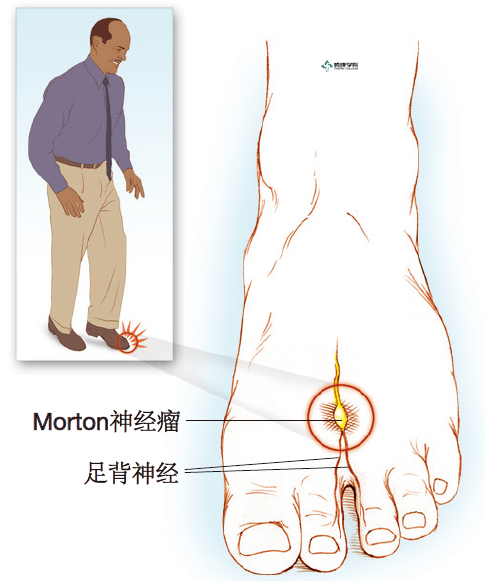 疼痛解剖学|morton神经瘤_手机搜狐网