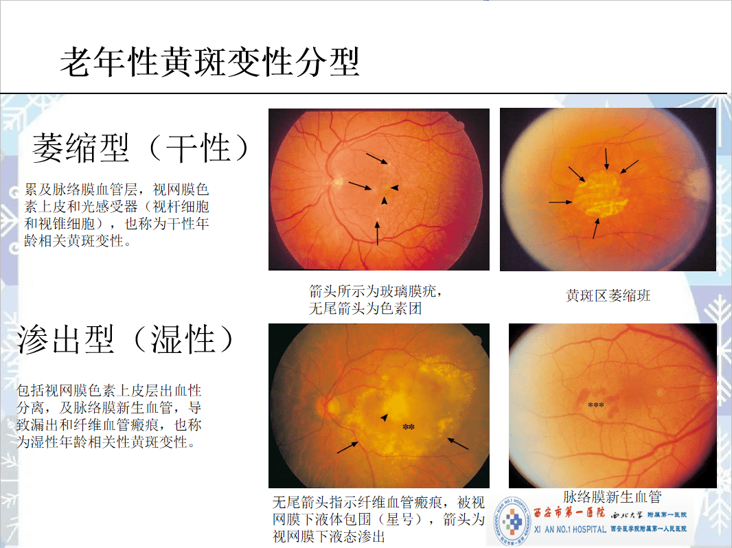 【爱眼护眼3】老年性(年龄相关性)黄斑变性