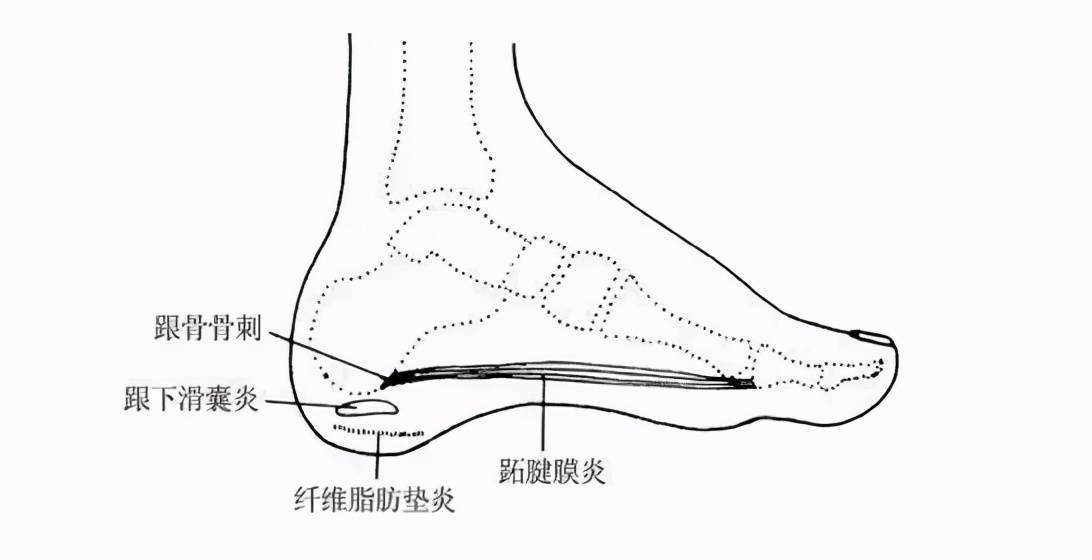 脚后跟经常痛要当心这3种治疗方法简单好用