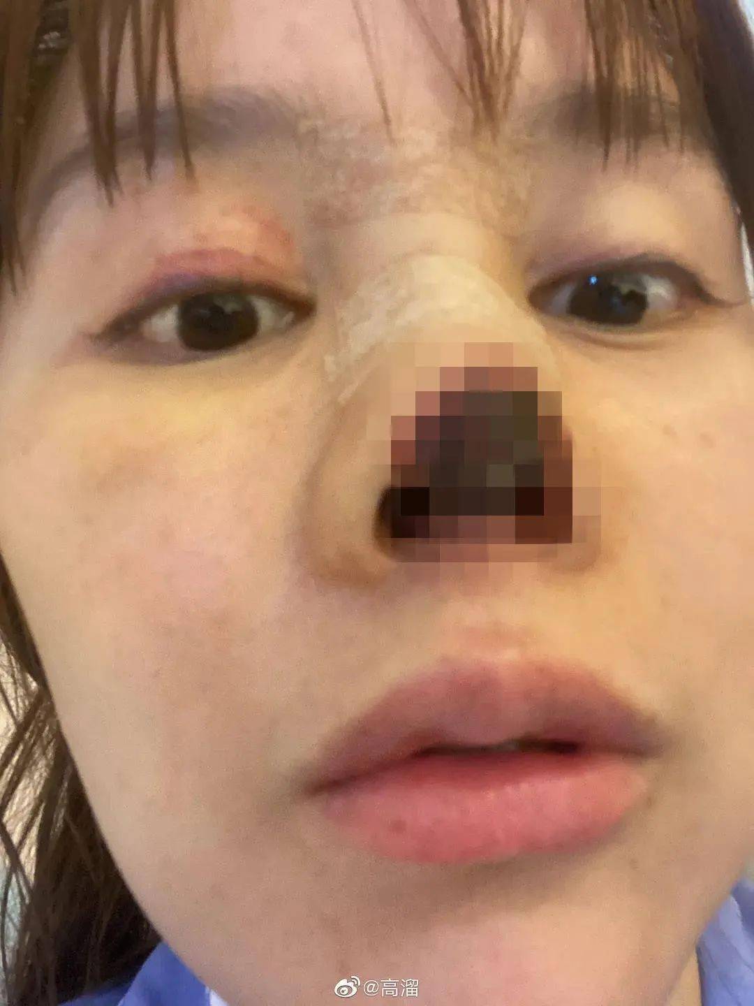 演员高溜自曝整容失败经历,鼻子坏