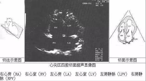 正常心脏b超解剖