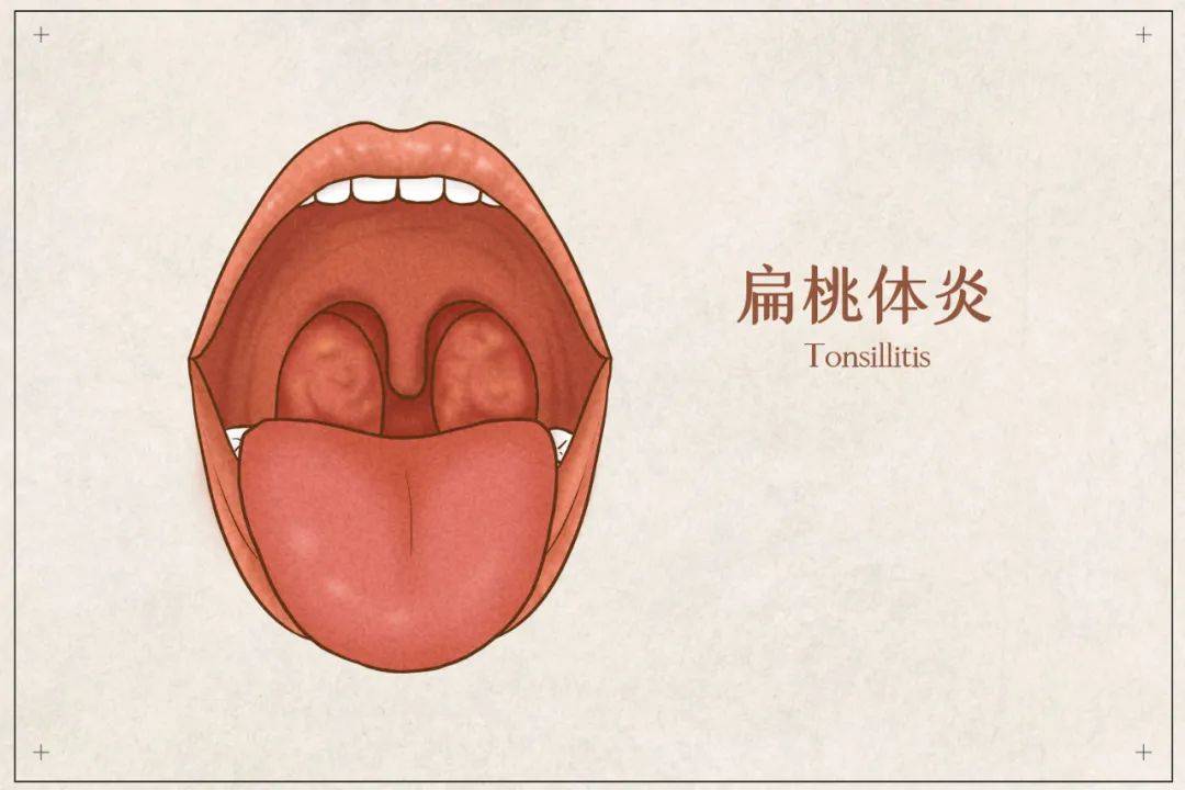 扁桃体发炎要不要割主要看这几种情况