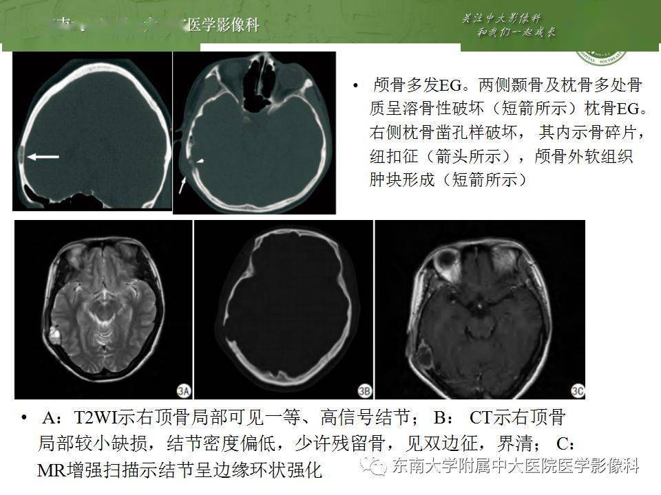 常见跨颅板疾病影像诊断