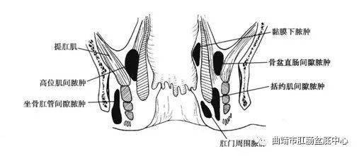 肛周脓肿可能发生的位置(图片引自《中华结直肠肛门外科学)肛周脓肿