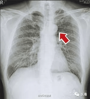 90%的受检者体检都会被胸片这个伪影吓到,是肺结节?