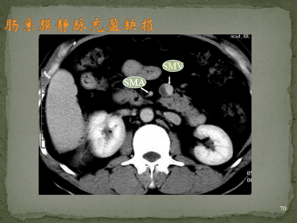 ct入门 | 肠梗阻的ct影像诊断