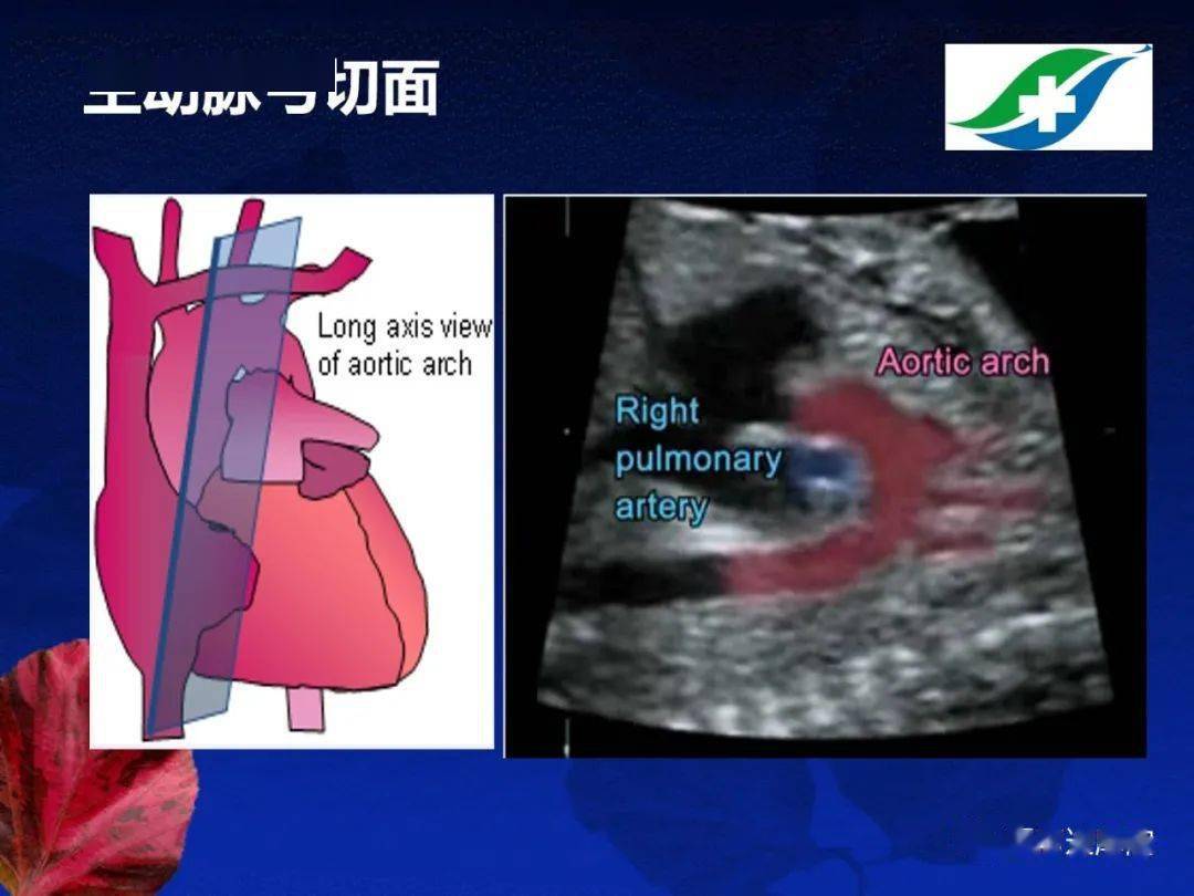 胎儿超声心动图基础及切面