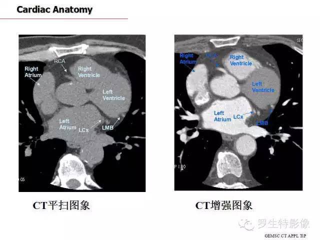 basal segment of lower lobe  下叶后基底段 心脏 美国心血管ct学会