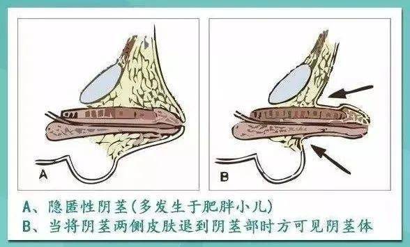 隐匿性阴茎怎么来的?