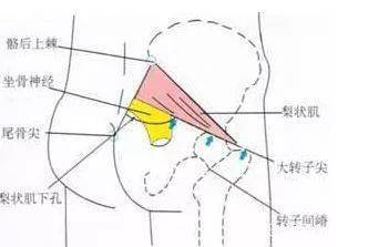 坐骨神经痛详解