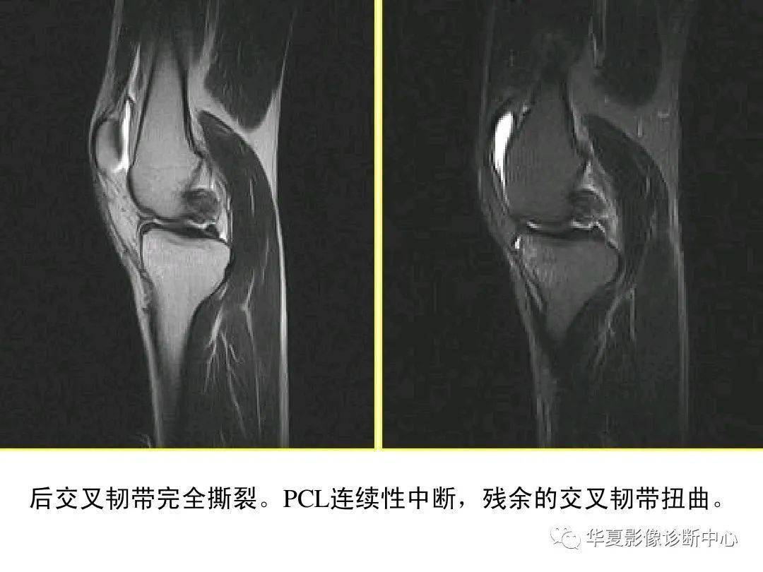 交叉韧带解剖及损伤的mri诊断