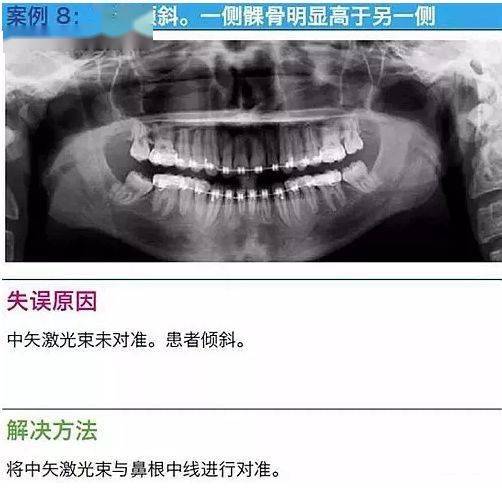 牙科拍摄全景片的十大经典失误案例及原因分析和解决方法