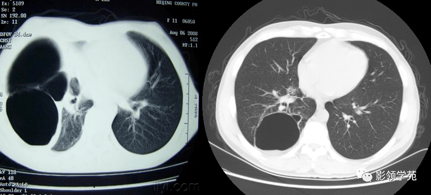 影像学表现 肺大泡是指由于各种原因导致肺泡腔内压力升高,肺泡壁