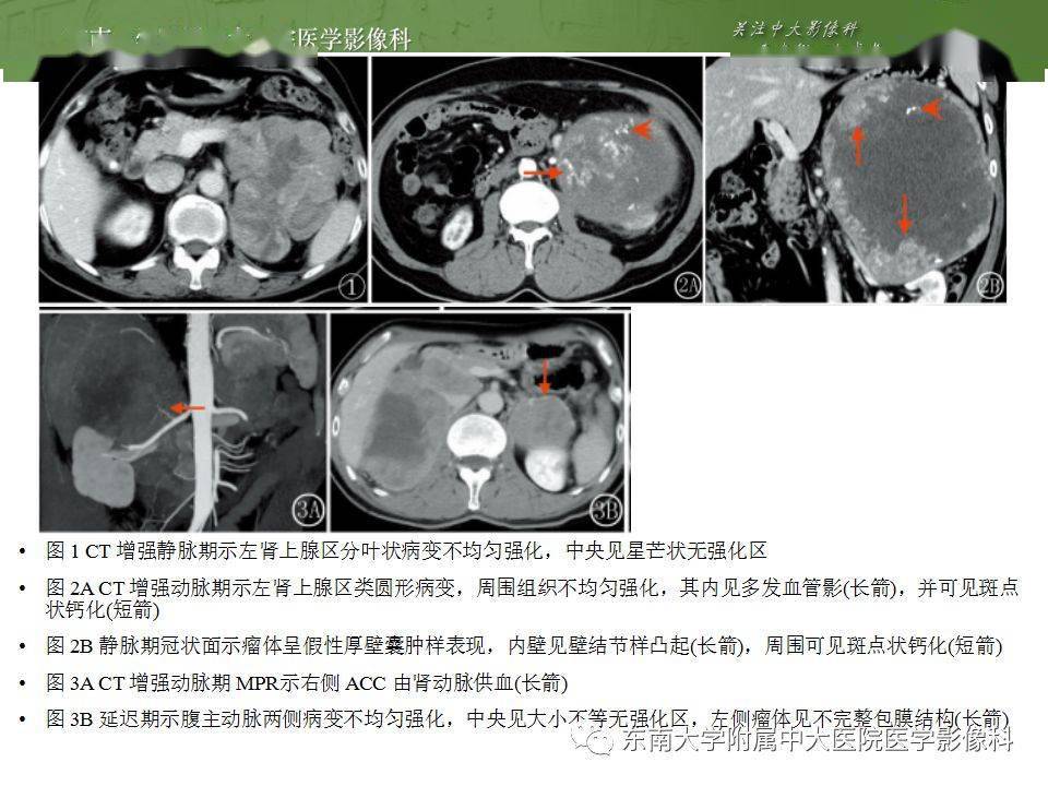 腹部肾上腺皮质癌影像诊断